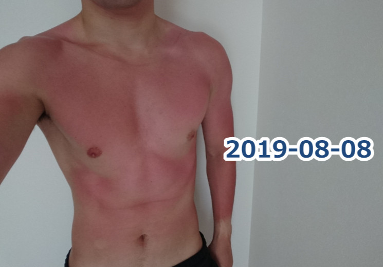 日焼けが痛くて筋トレできない…日焼け時に食べるべき栄養